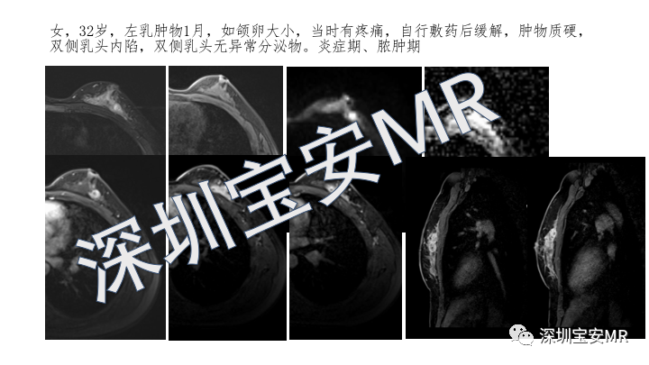 【PPT】浆细胞性乳腺炎的MRI诊断-14