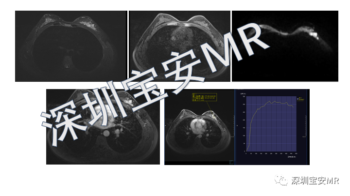 【PPT】浆细胞性乳腺炎的MRI诊断-15
