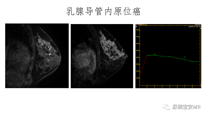 【PPT】浆细胞性乳腺炎的MRI诊断-17
