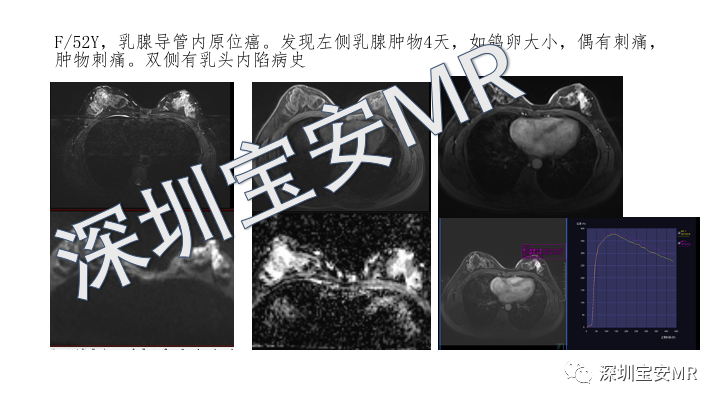 【PPT】浆细胞性乳腺炎的MRI诊断-18