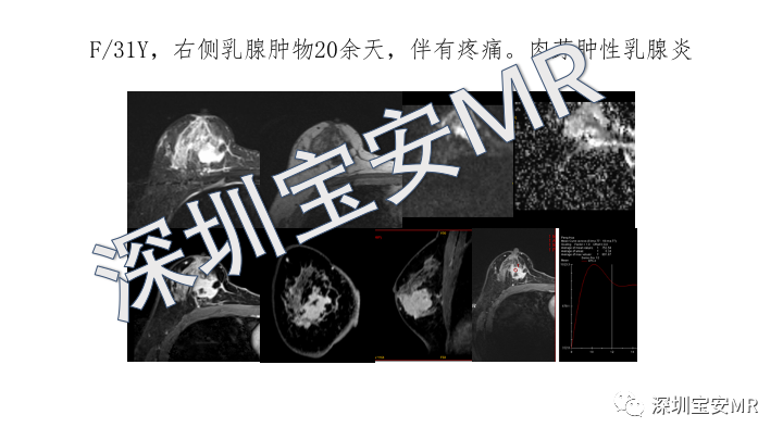 【PPT】浆细胞性乳腺炎的MRI诊断-19
