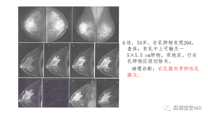 【PPT】浆细胞性乳腺炎的MRI诊断-20