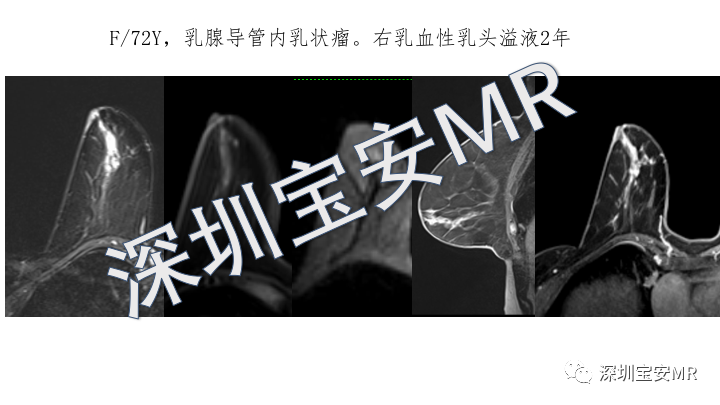 【PPT】浆细胞性乳腺炎的MRI诊断-21