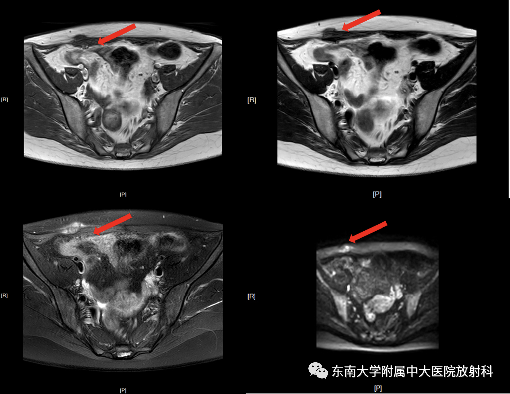 【PPT】子宫内膜异位症-1
