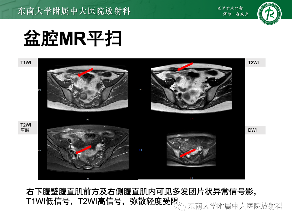 【PPT】子宫内膜异位症-3