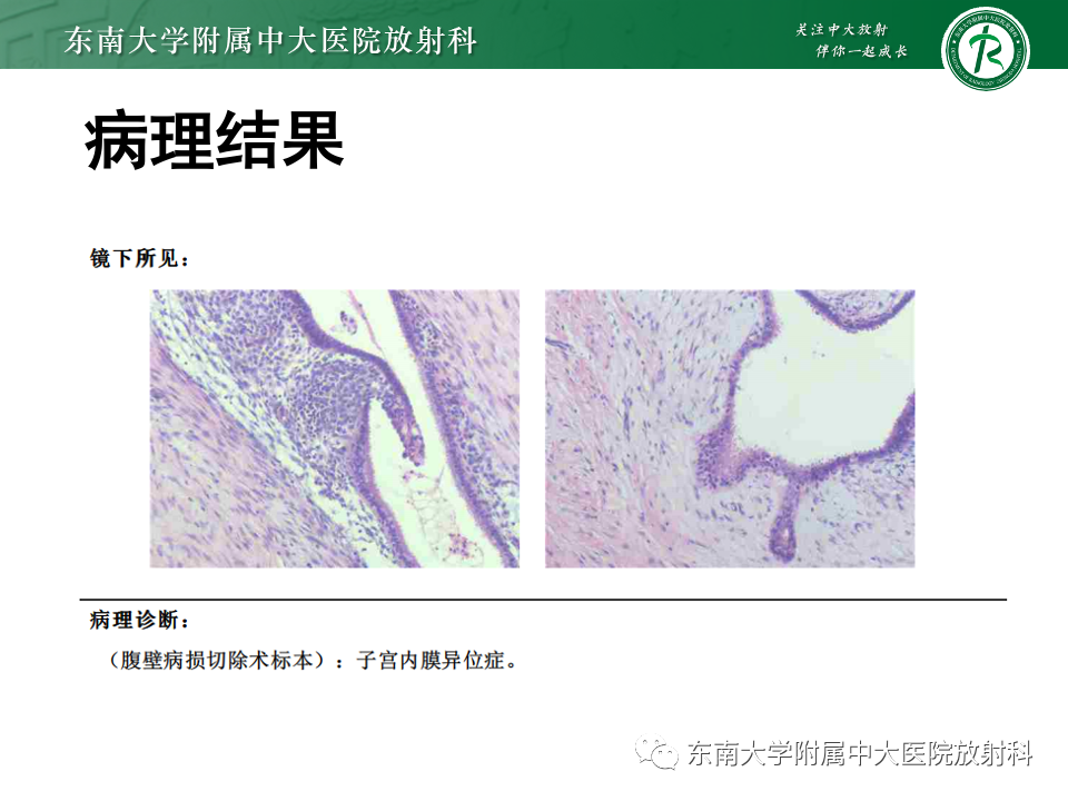 【PPT】子宫内膜异位症-4