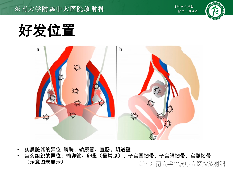 【PPT】子宫内膜异位症-8