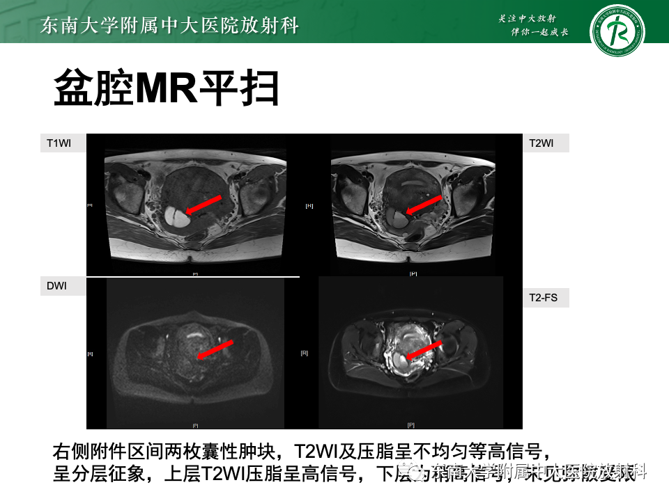 【PPT】子宫内膜异位症-18
