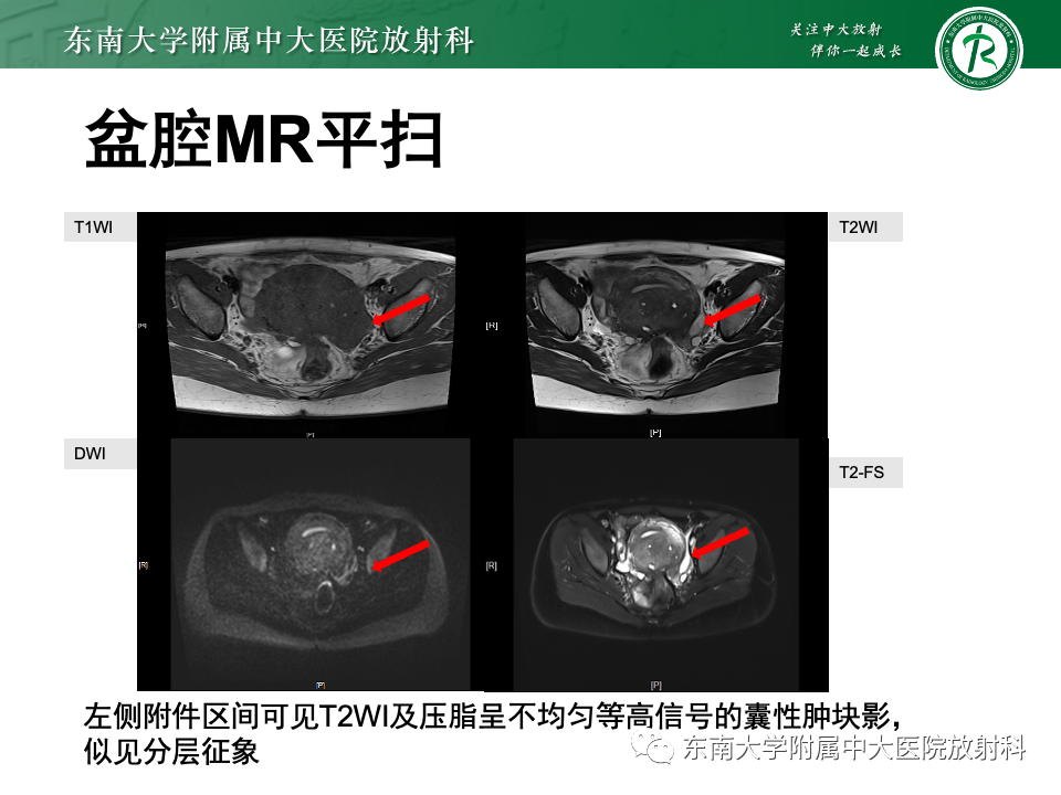【PPT】子宫内膜异位症-19