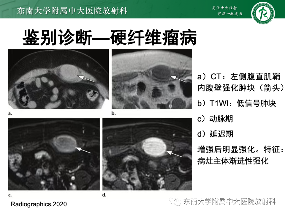 【PPT】子宫内膜异位症-28