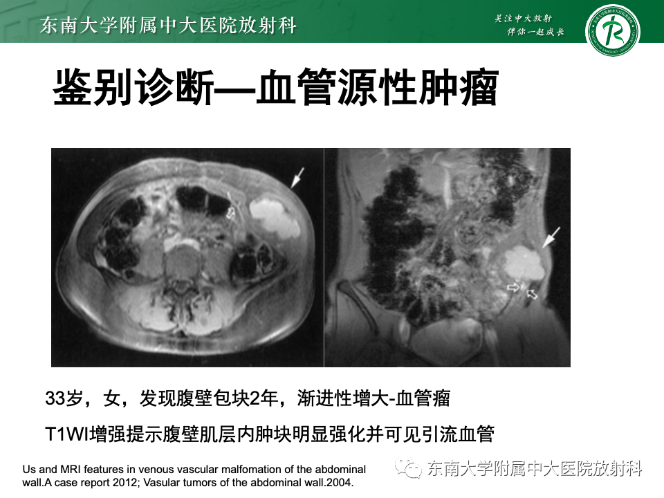 【PPT】子宫内膜异位症-31