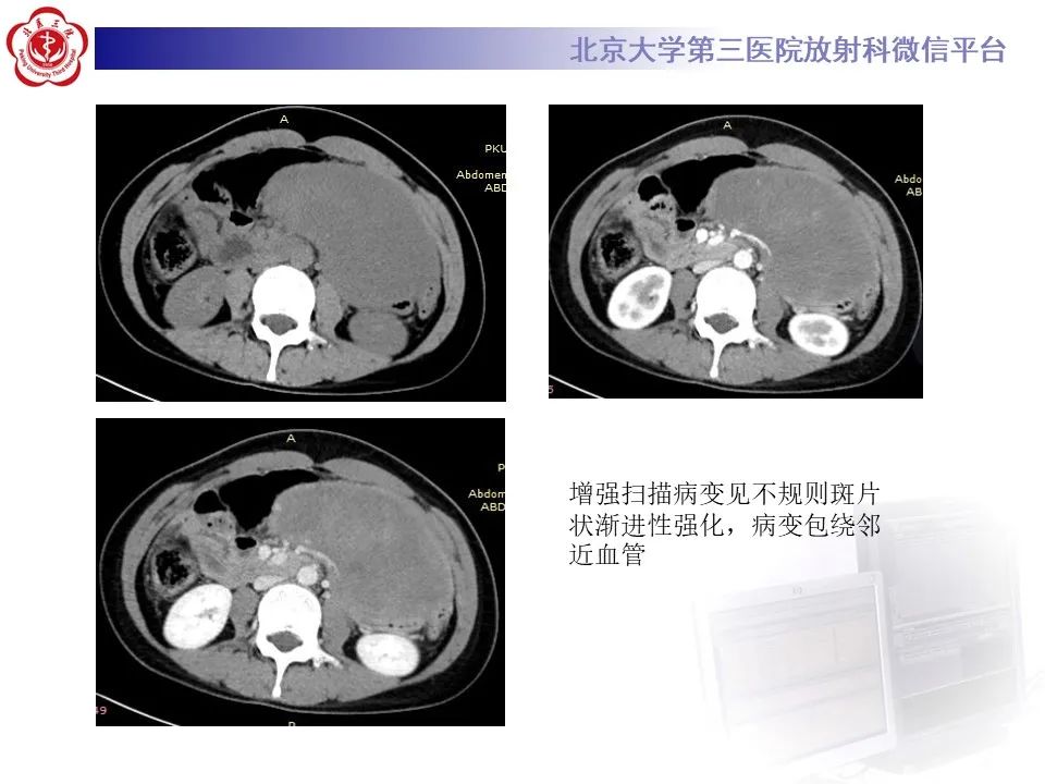 【PPT】侵袭性纤维瘤病（腹内型）-4