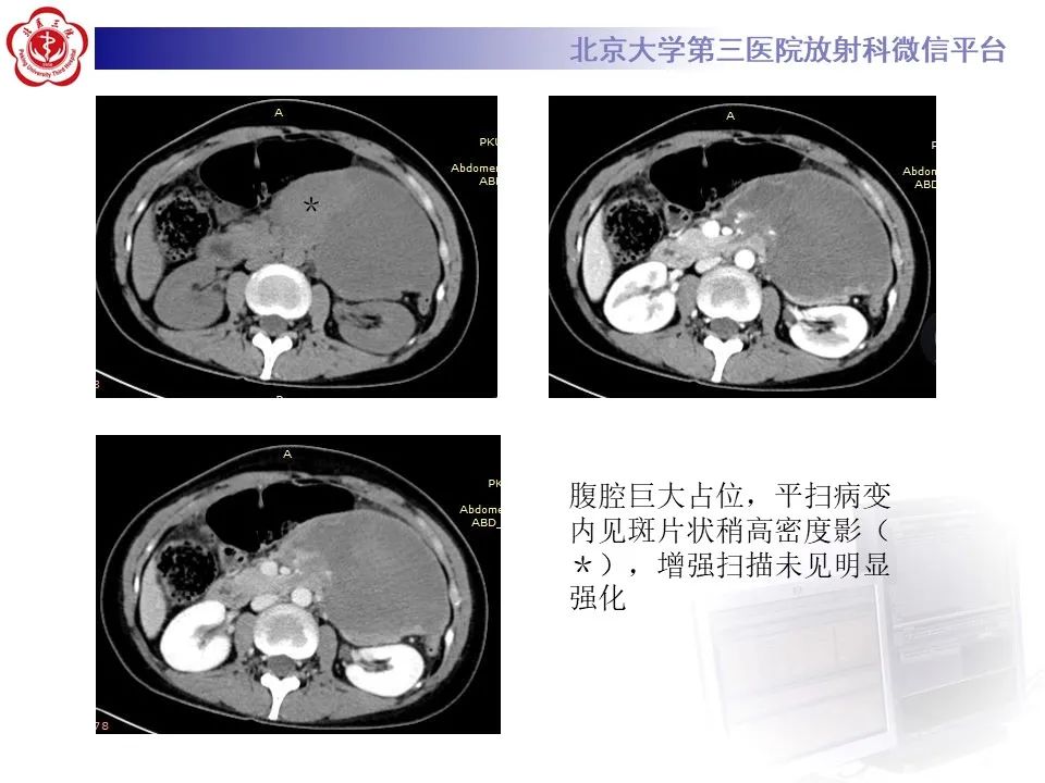【PPT】侵袭性纤维瘤病（腹内型）-3