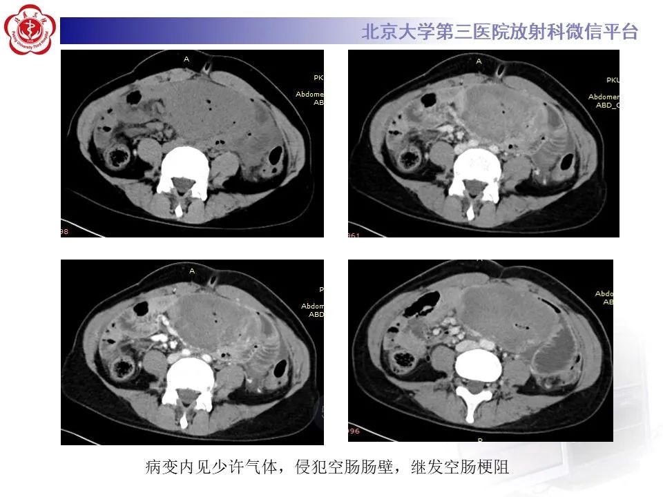 【PPT】侵袭性纤维瘤病（腹内型）-5