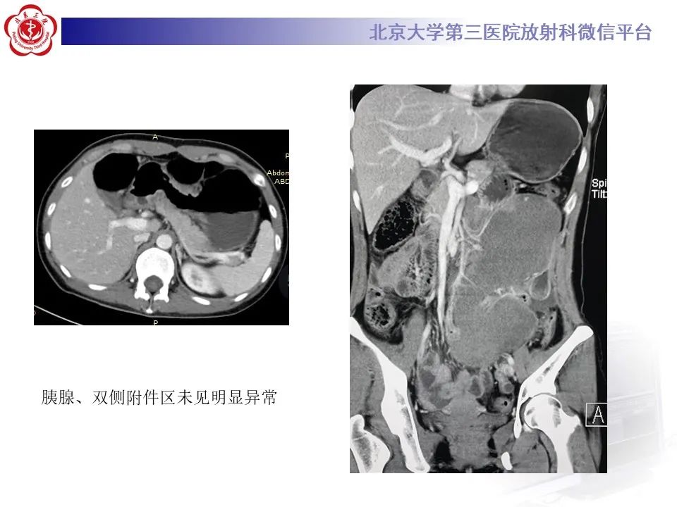 【PPT】侵袭性纤维瘤病（腹内型）-6