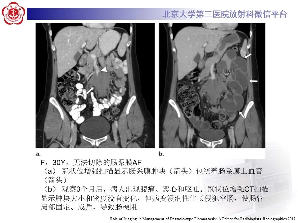 【PPT】侵袭性纤维瘤病（腹内型）-17