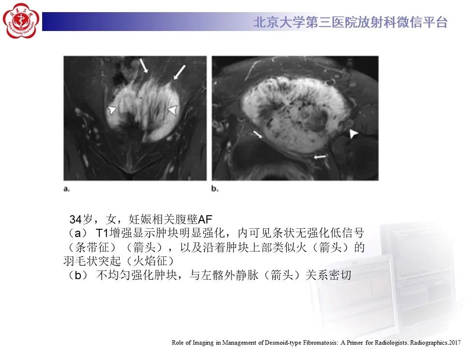【PPT】侵袭性纤维瘤病（腹内型）-20