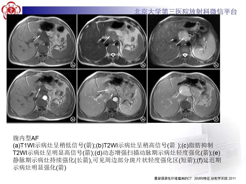 【PPT】侵袭性纤维瘤病（腹内型）-21