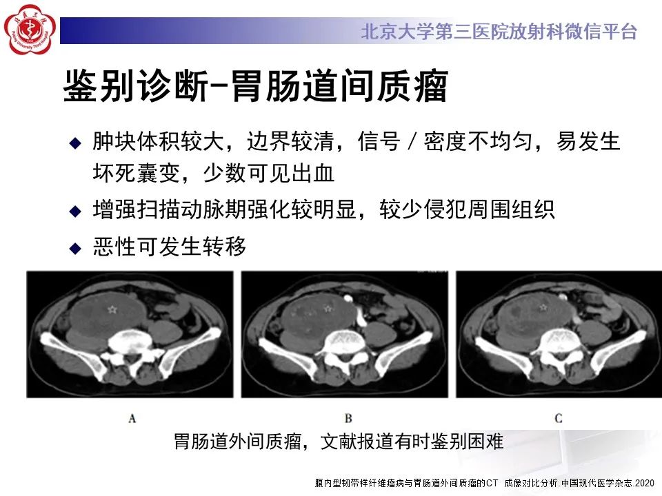 【PPT】侵袭性纤维瘤病（腹内型）-23