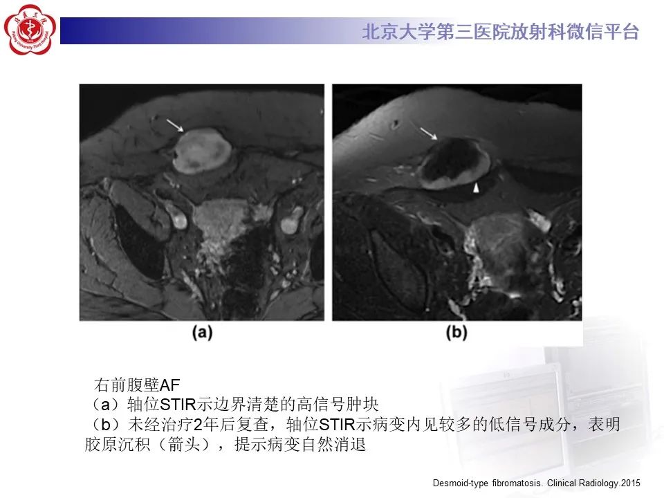 【PPT】侵袭性纤维瘤病（腹内型）-28