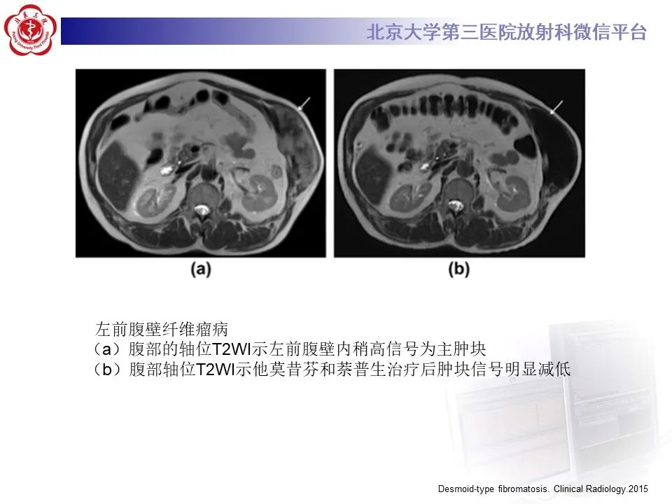 【PPT】侵袭性纤维瘤病（腹内型）-29