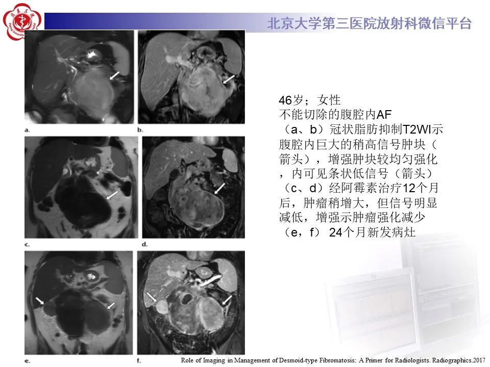 【PPT】侵袭性纤维瘤病（腹内型）-30
