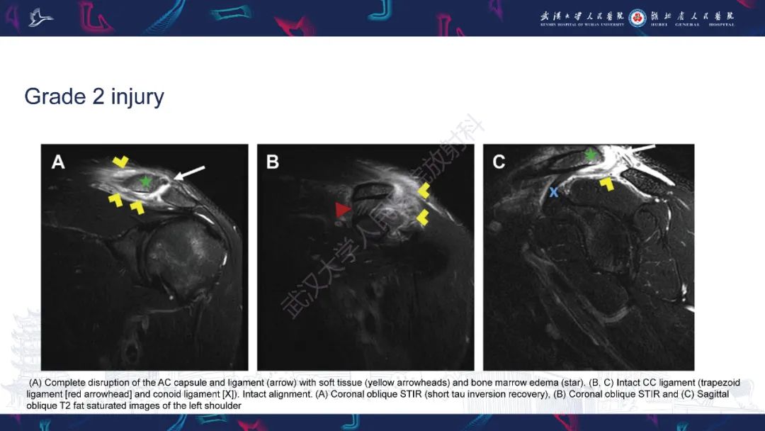 【PPT】肩锁关节病变影像诊断-16