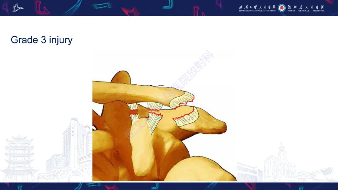 【PPT】肩锁关节病变影像诊断-18