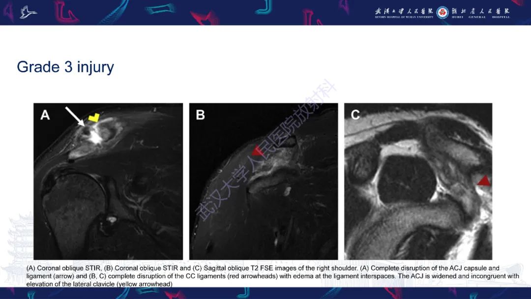 【PPT】肩锁关节病变影像诊断-19