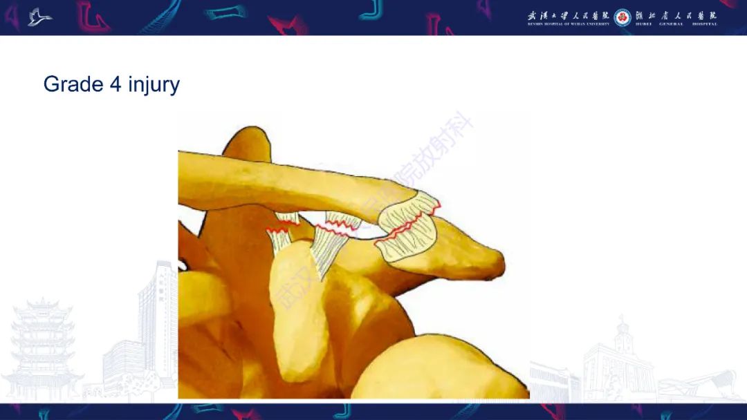 【PPT】肩锁关节病变影像诊断-21