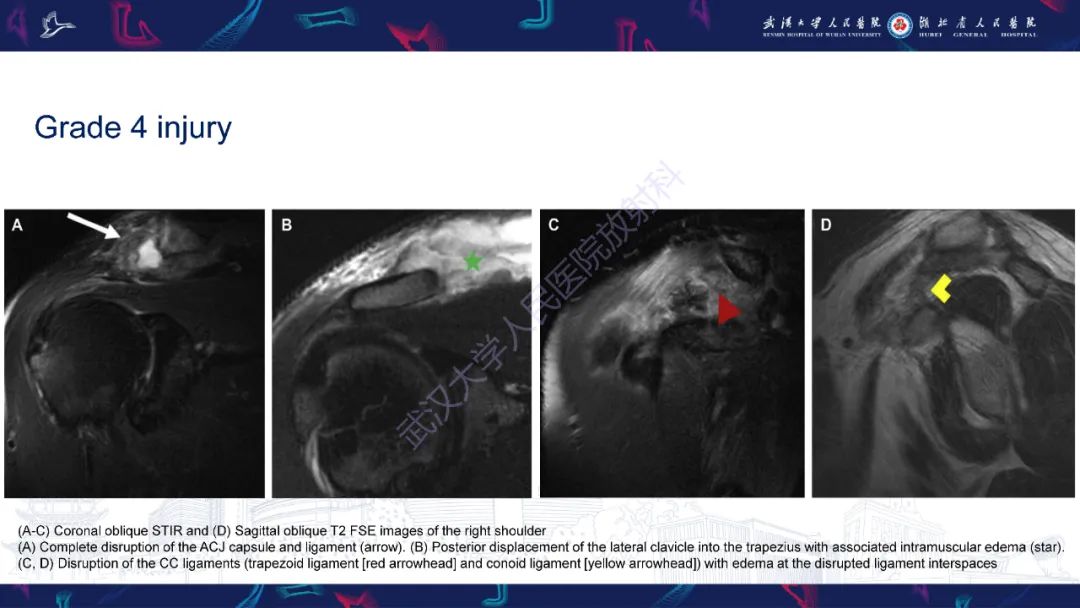 【PPT】肩锁关节病变影像诊断-22