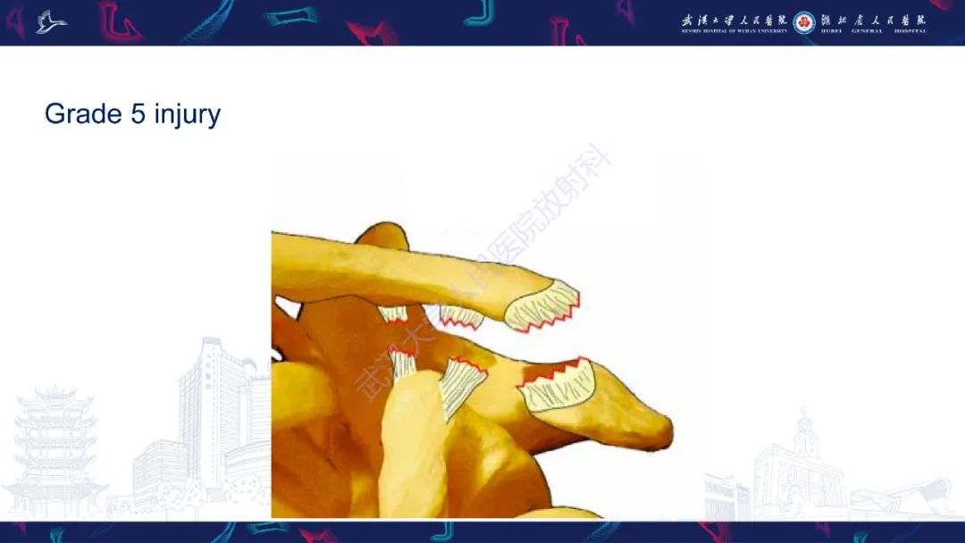 【PPT】肩锁关节病变影像诊断-24