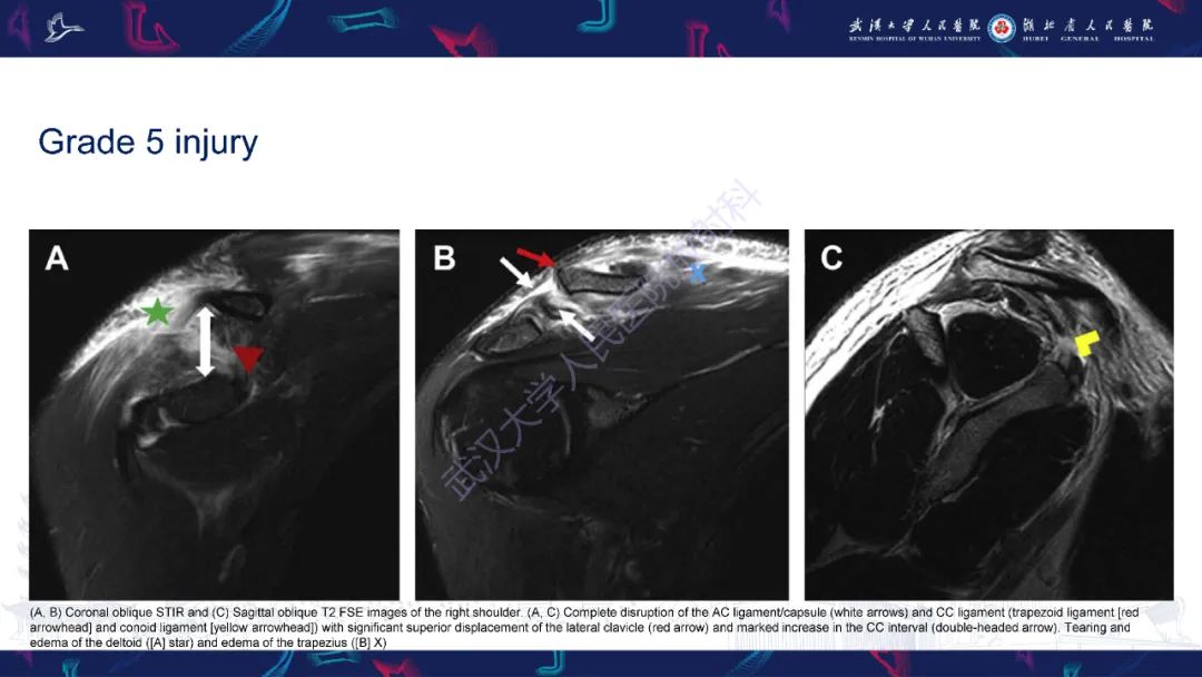 【PPT】肩锁关节病变影像诊断-25