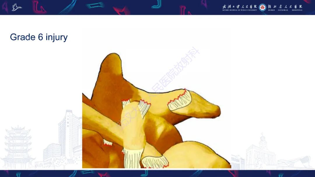 【PPT】肩锁关节病变影像诊断-27