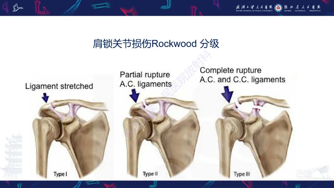 【PPT】肩锁关节病变影像诊断-28