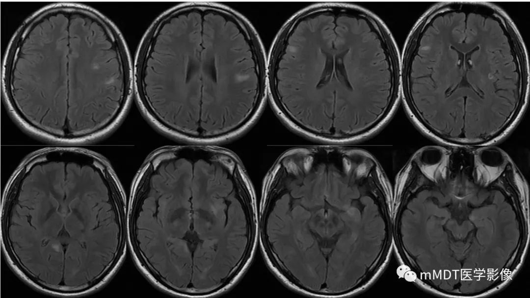 【PPT】神经白塞病NBD-4