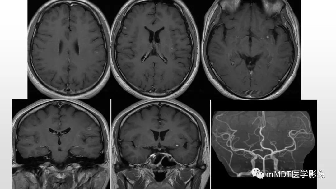【PPT】神经白塞病NBD-5
