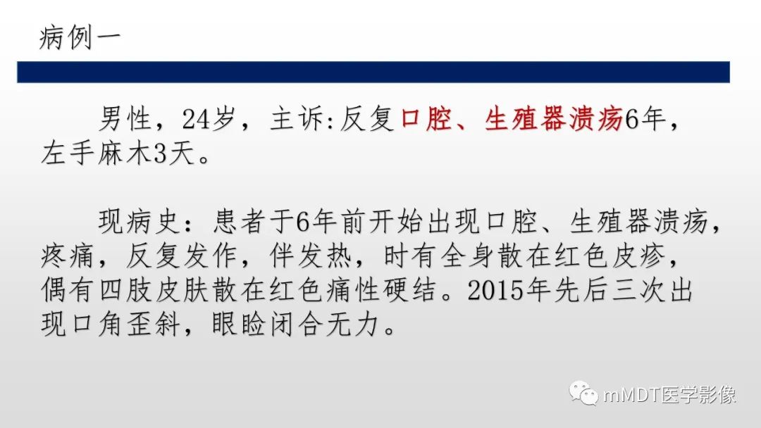 【PPT】神经白塞病NBD-2