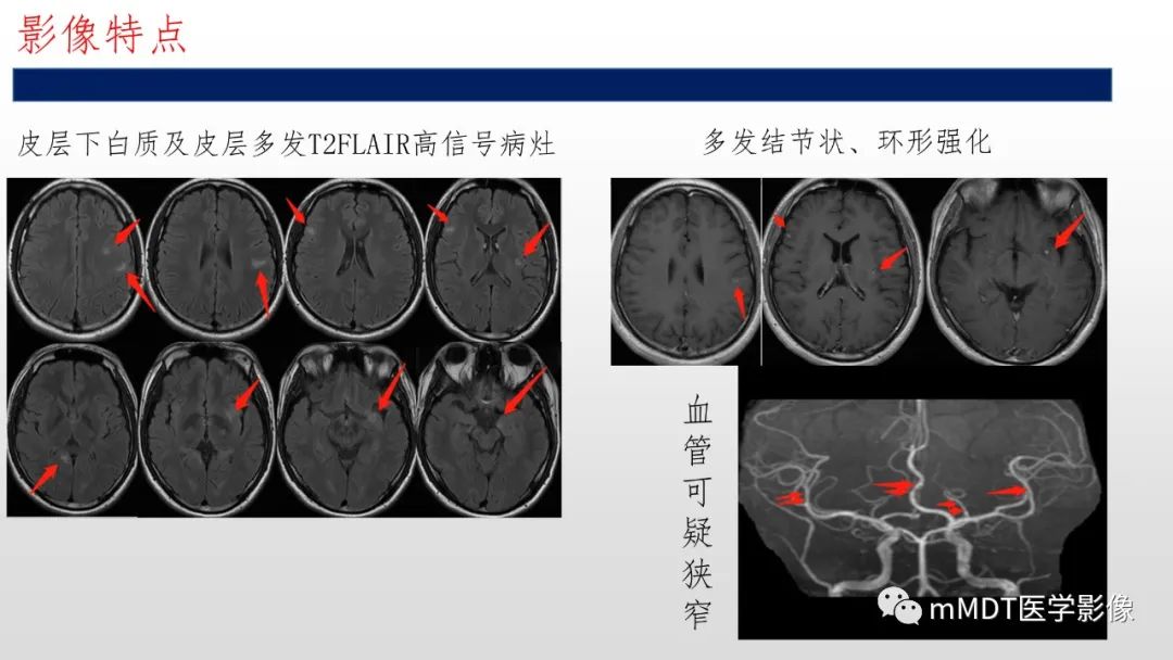 【PPT】神经白塞病NBD-6