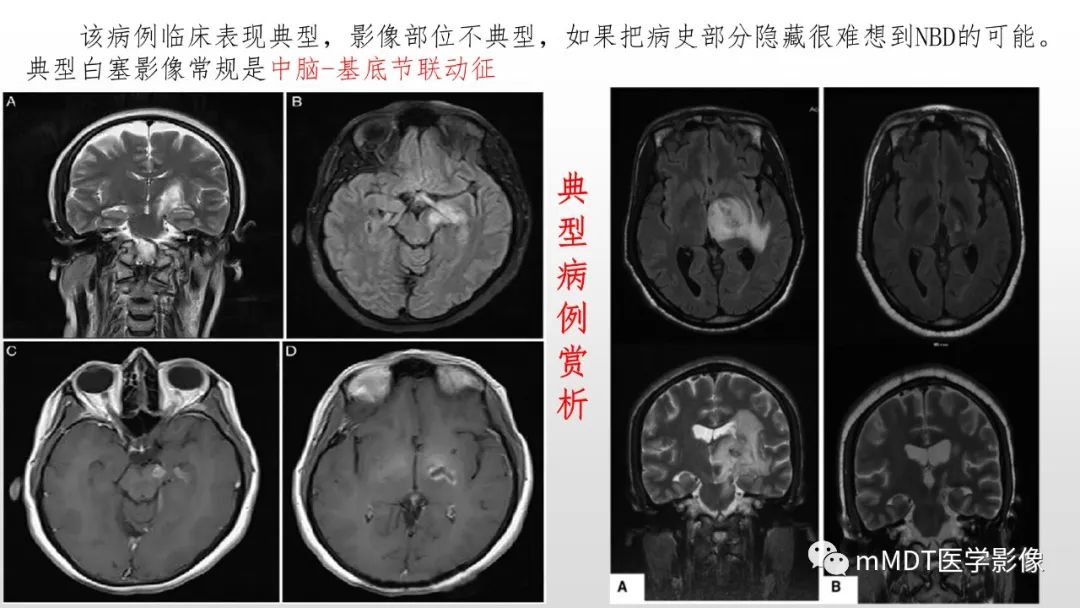 【PPT】神经白塞病NBD-11