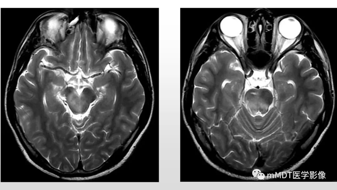 【PPT】神经白塞病NBD-14