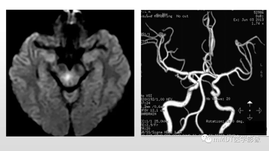【PPT】神经白塞病NBD-15
