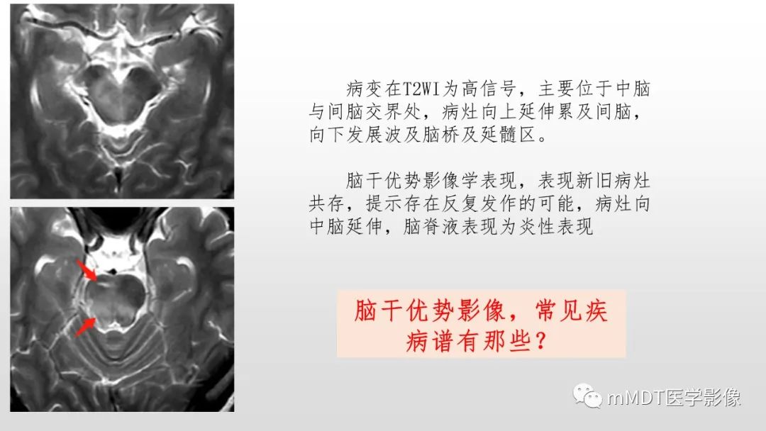 【PPT】神经白塞病NBD-16