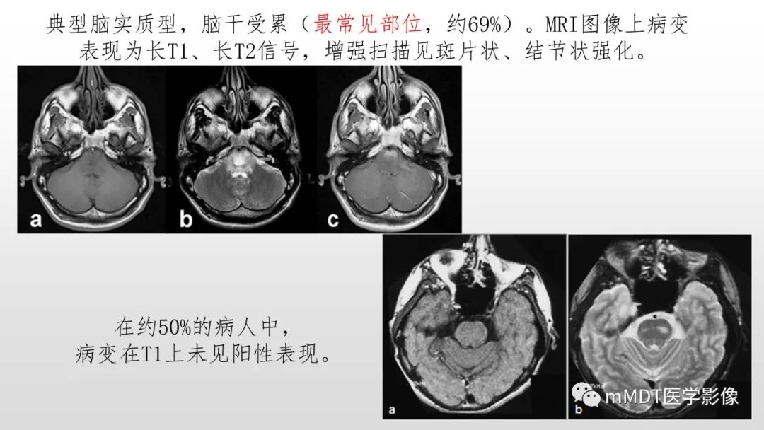 【PPT】神经白塞病NBD-27