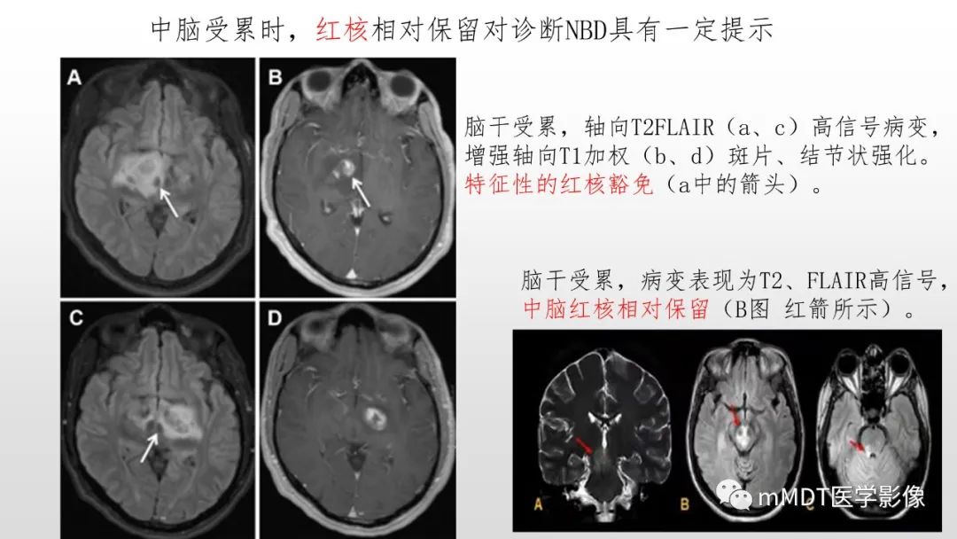 【PPT】神经白塞病NBD-30