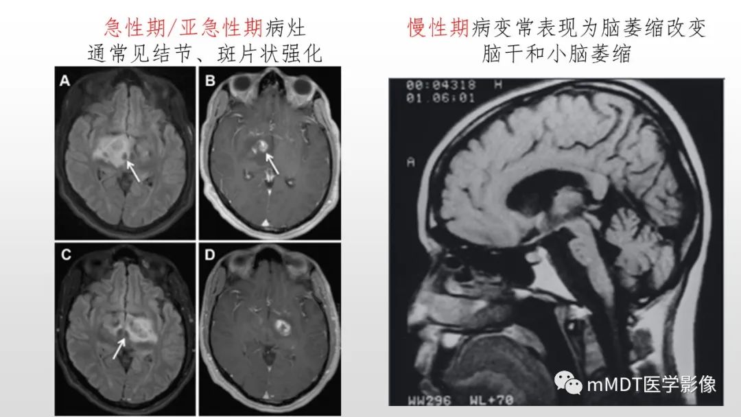 【PPT】神经白塞病NBD-29