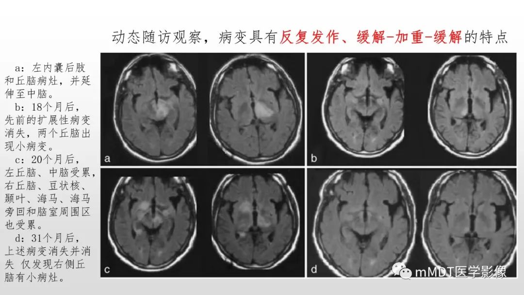 【PPT】神经白塞病NBD-31