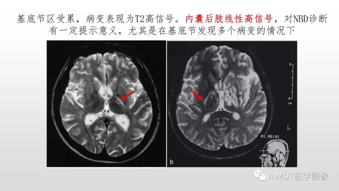 【PPT】神经白塞病NBD-32