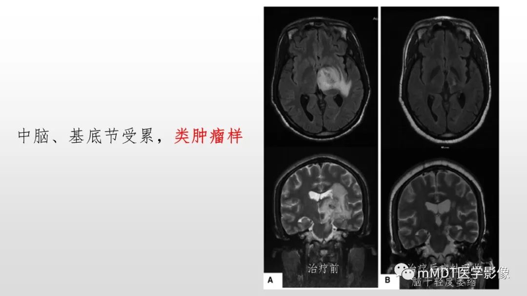 【PPT】神经白塞病NBD-35
