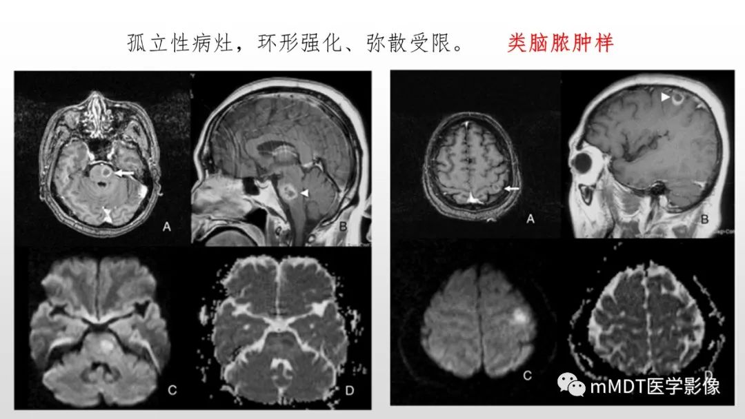 【PPT】神经白塞病NBD-36